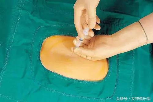 无痛分娩后期会腰痛吗,无痛分娩后期有危险吗