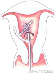 白带带一条血丝是宫颈癌吗,白带带血是什么炎症