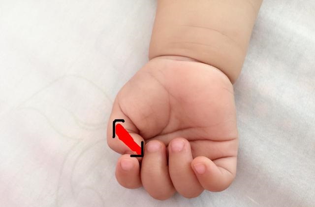 黄疸指数超过15就是病理性黄疸吗,宝宝黄疸偏高宝妈吃什么可以缓解