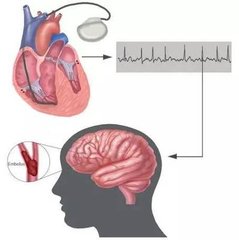 抗凝治疗会引起消化道出血吗,哪些房颤患者需要进行抗凝治疗