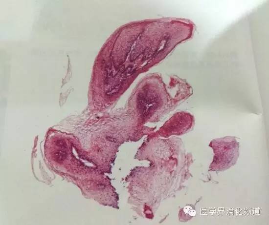 食管良性肿瘤科普视频,食管乳头状瘤和增生区别