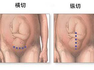 剖腹产竖切刀口比横切刀口恢复慢,产前一定要知道什么