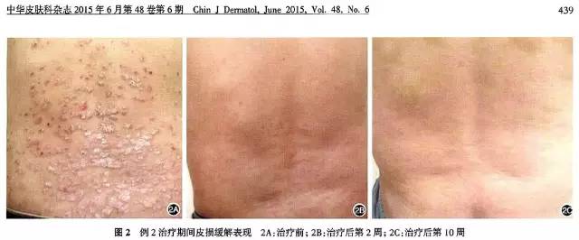 银屑病生物制剂可善挺,银屑病用生物制剂效果如何