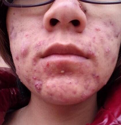 痘疮最好的治疗方法,痘疮该如何治