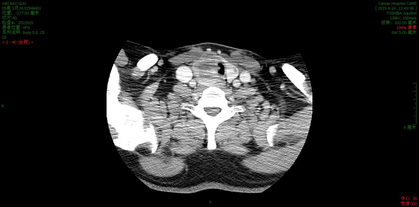 突然间声音变哑是什么原因呢,声音变沙哑了要做什么检查
