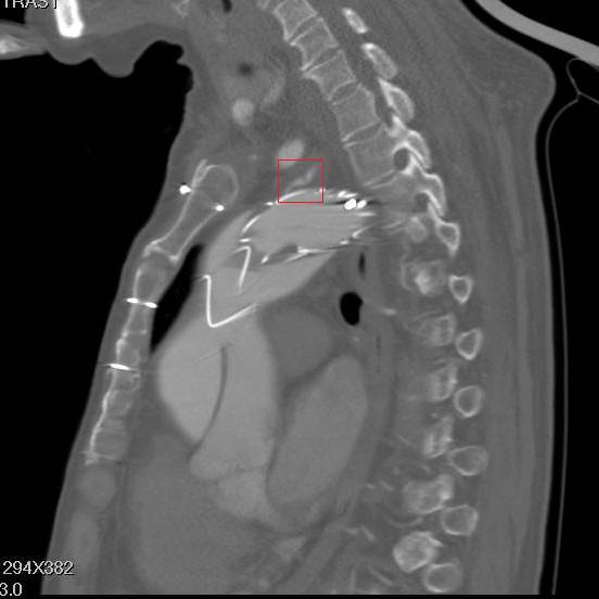 主动脉夹层袭来的恐慌,你不懂