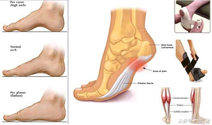 脚底板酸痛快速缓解方法,怎么缓解脚底板酸痛