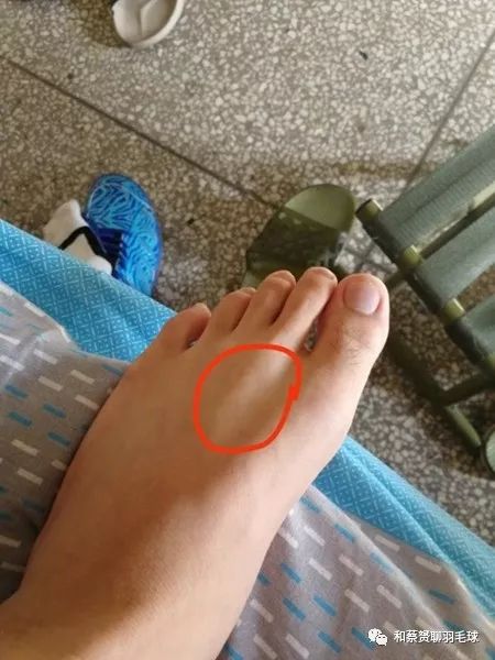 小腿前面的肌肉僵硬,小腿前方肌肉僵硬