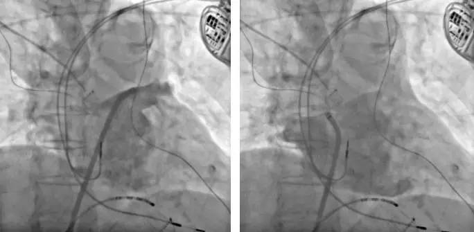 马长生房颤的最好治疗方法,马长生房颤消融后复发