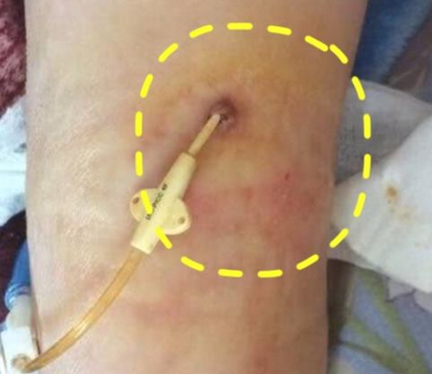 穿刺导致血液细菌感染怎么办,输液港穿刺点感染的原因