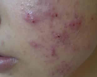 年轻人最熟悉的“青春痘”，是一种什么样的皮肤病？