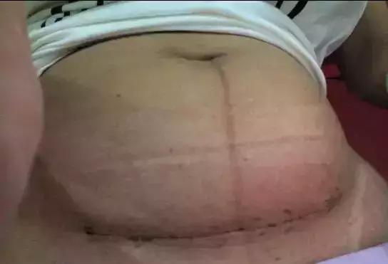 剖腹产后45天伤口有撕裂疼,剖腹产后20天肚子伤口裂开了