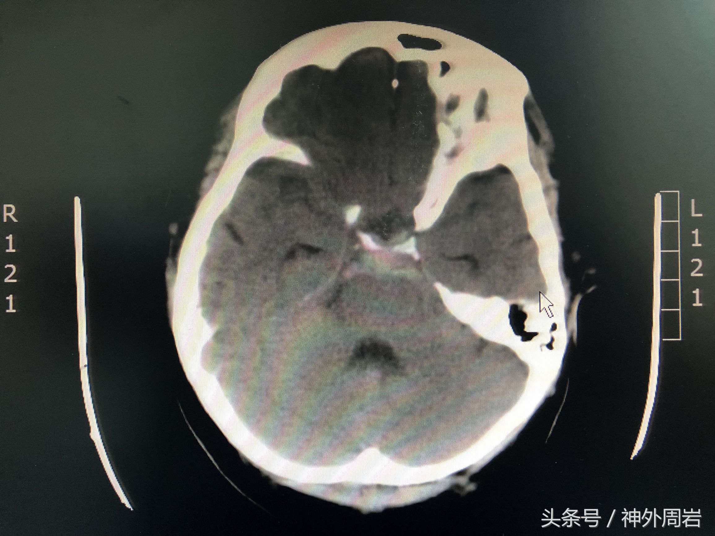 妊娠反应头疼怎么回事,妊娠高血压产后头痛严重吗