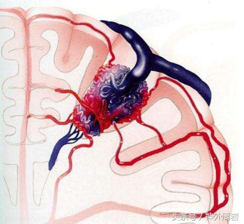 妊娠反应头疼怎么回事,妊娠高血压产后头痛严重吗