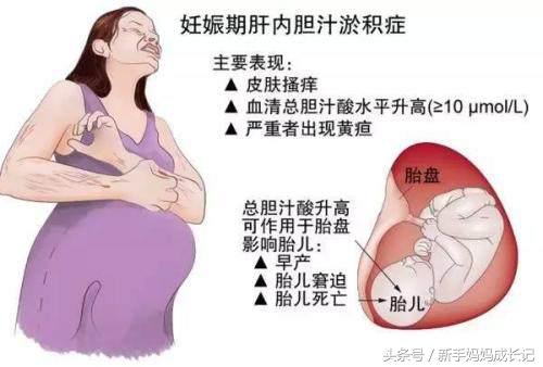 孕期身体痒莫不当回事，妊娠期肝内胆汁淤积（ICP）很危险！