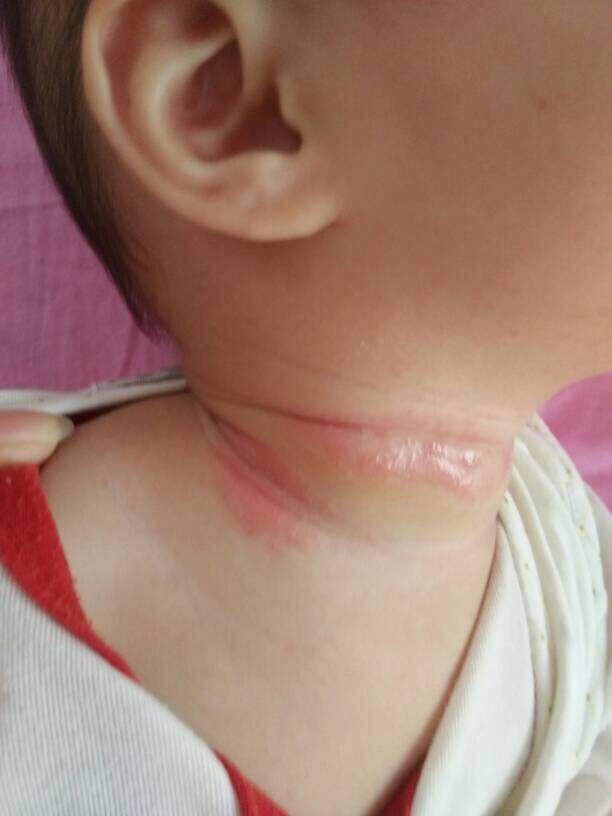 婴儿脖子出汗淹脖子怎么办,宝宝淹脖子严重会怎样