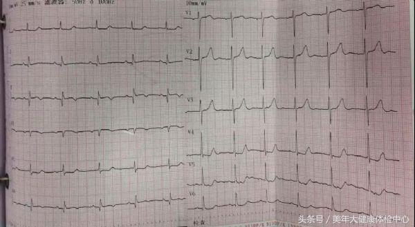 服用华法林患者出现脾脏梗死,服用华法林的案例