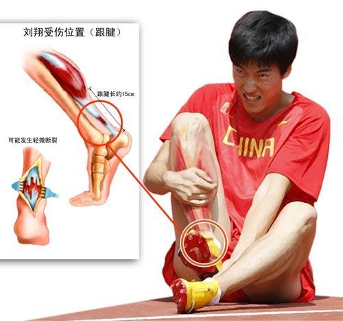 跟腱断裂mr诊断模板,美国跟腱断裂修复手术