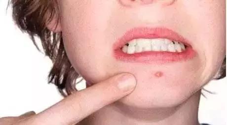 怎么去除脸上的黑痘印红痘印,教你轻松祛除痘印的方法