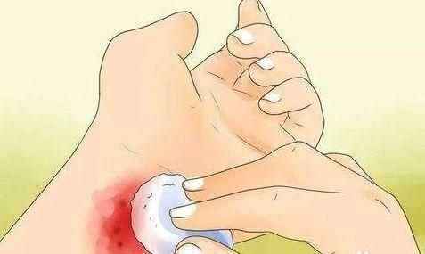 孩子擦破皮的脸需要怎么处理,小孩子被剪刀划伤要打破伤风吗