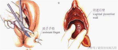 撕裂和侧切哪个好恢复,顺产侧切和撕裂哪个好恢复