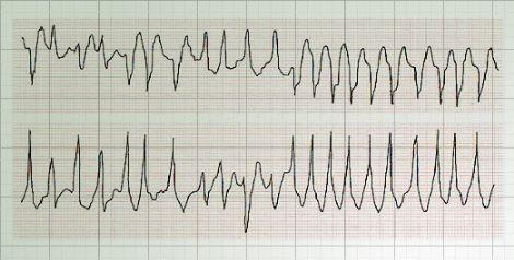 肺心病能引起哪些疾病,肺心病人心脏疼怎么办