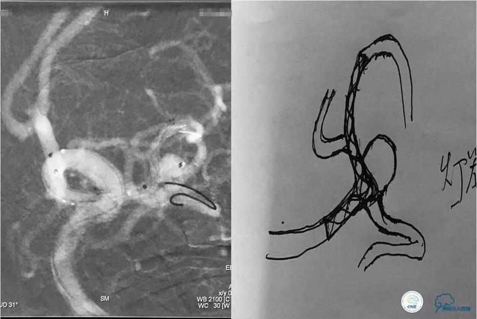 脑动脉瘤并颈动脉狭窄怎么治疗,脑动脉血管狭窄介入治疗效果好吗