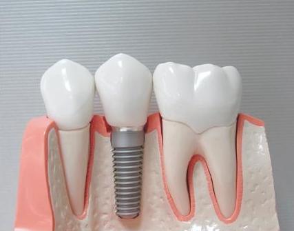 缺牙会引起口腔问题,缺牙怎么治疗不影响做核磁