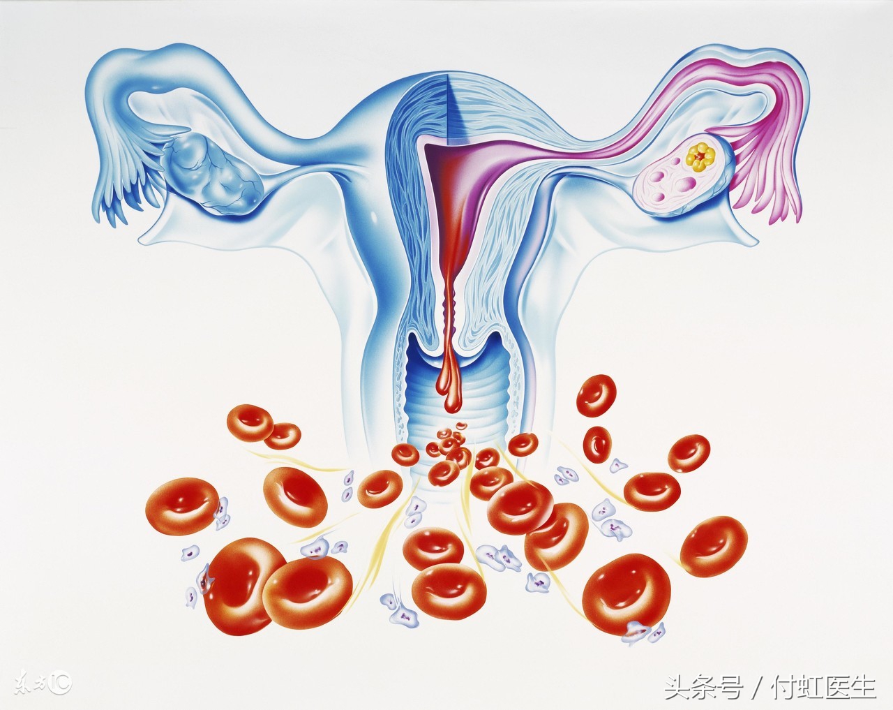 妇科炎症导致的盆腔炎怎么治,湿热型盆腔炎怎么调理