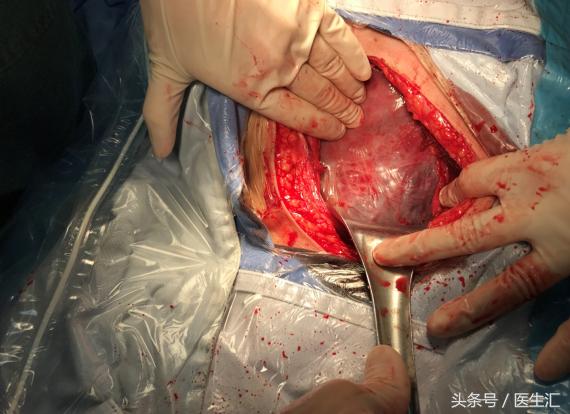 凶险性前置胎盘风险多大,孕28周臀位边缘性前置胎盘