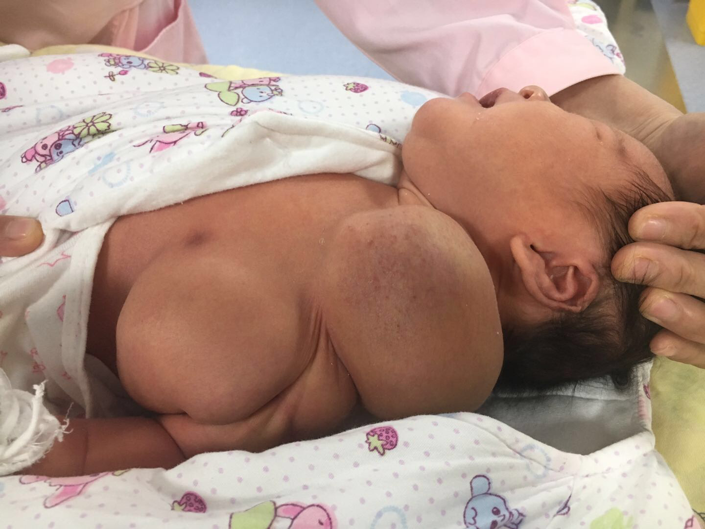 刚出生婴儿头顶有个凸起的包,新生儿右脖子有个小肿块