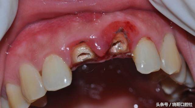 门牙磕掉一个角补了能维持多久,门牙断了一角怎么补