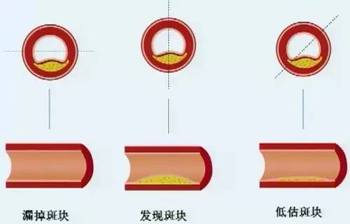 微课堂牢记三要诀，轻松看懂冠脉CTA