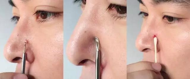 挤痘痘的正确手法图解,挤痘不留印的正确方法