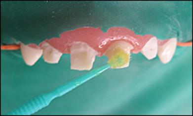 乳前牙预成冠补牙过程,乳前牙龋坏修复