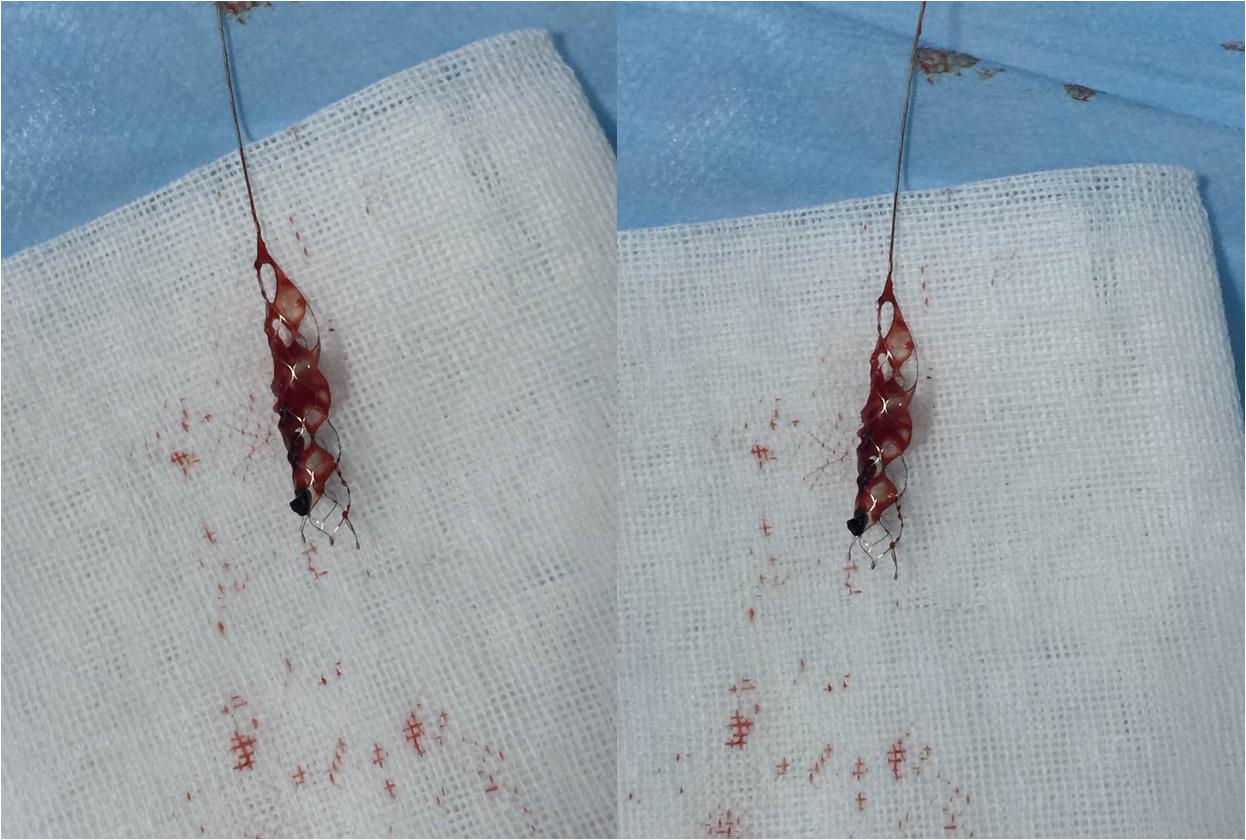 取栓慢性闭塞如何避免血栓逃逸,急性大脑中动脉栓塞取栓时间