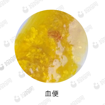 宝宝拉这几种便便要去医院,宝宝有问题的便便是怎样的