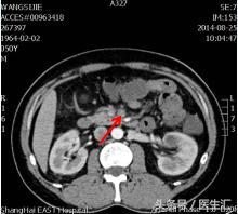呕吐吐出咖啡色液体怎么回事,呕吐出黄色液体后怎么处理
