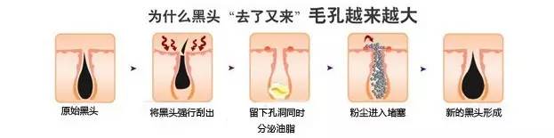 黑头一挤就缩回去,黑头挤了两三次会变大嘛