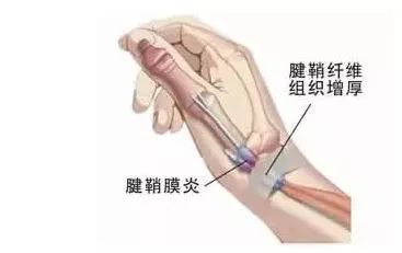 「可怕」一男子玩手机导致手指出现活动障碍！严重可致终生障碍！