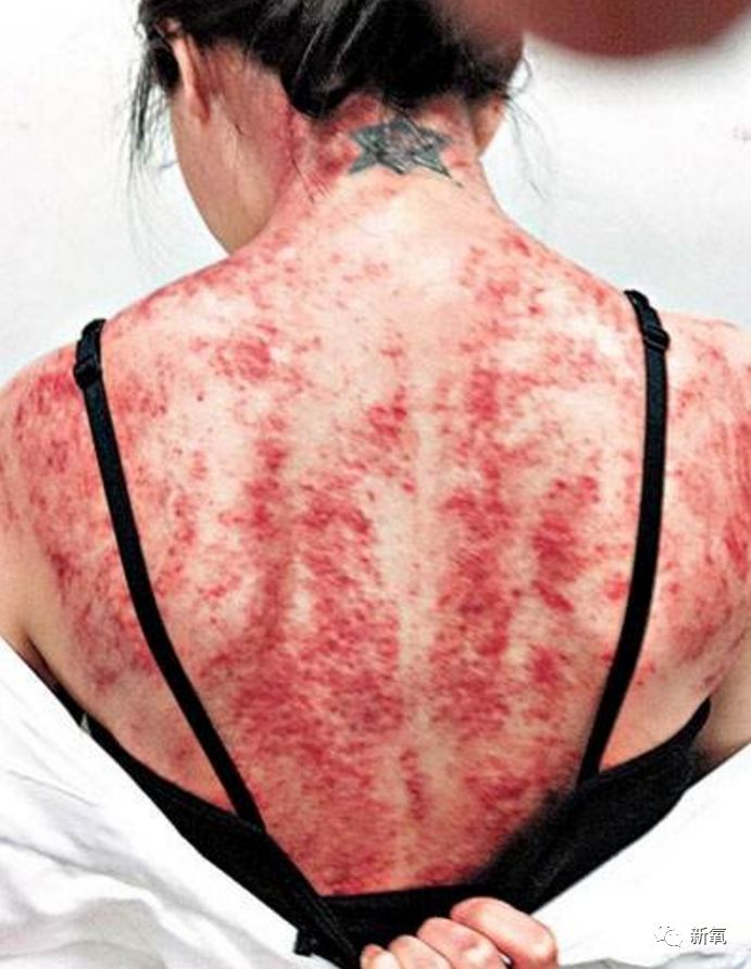 阿娇刮痧后背效果,阿娇被吓哭