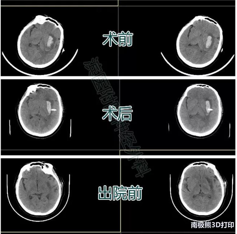 医学3d动画演示脑出血手术,3d演示脑出血治疗过程