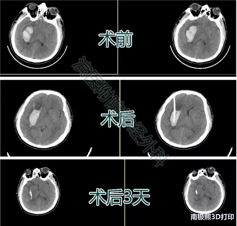 医学3d动画演示脑出血手术,3d演示脑出血治疗过程