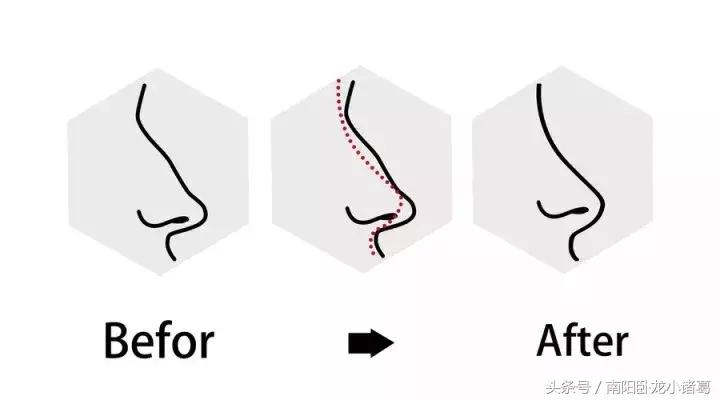 假体在鼻子里能保持一辈子吗,鼻子假体时间长会缩小还是会膨胀