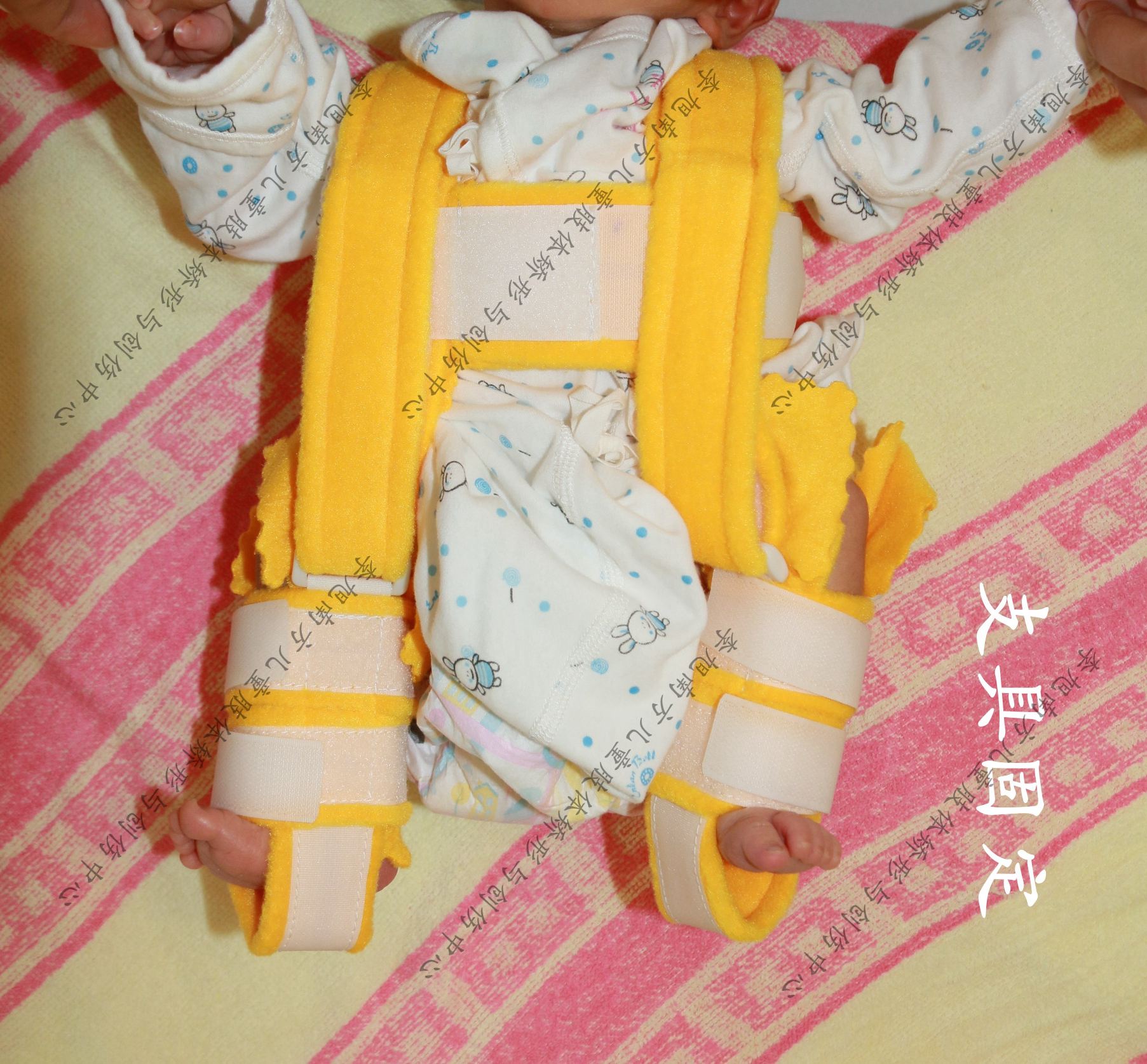 股骨干骨折术后功能锻炼,儿童股骨干骨折治疗方案