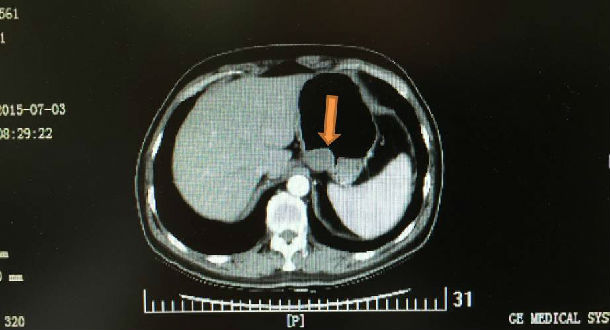 胃肠道间质瘤在临床上有什么特点,胃肠道间质瘤会有什么特征