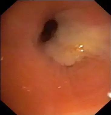 反复咳嗽、支气管炎老不好?当心异物在作祟