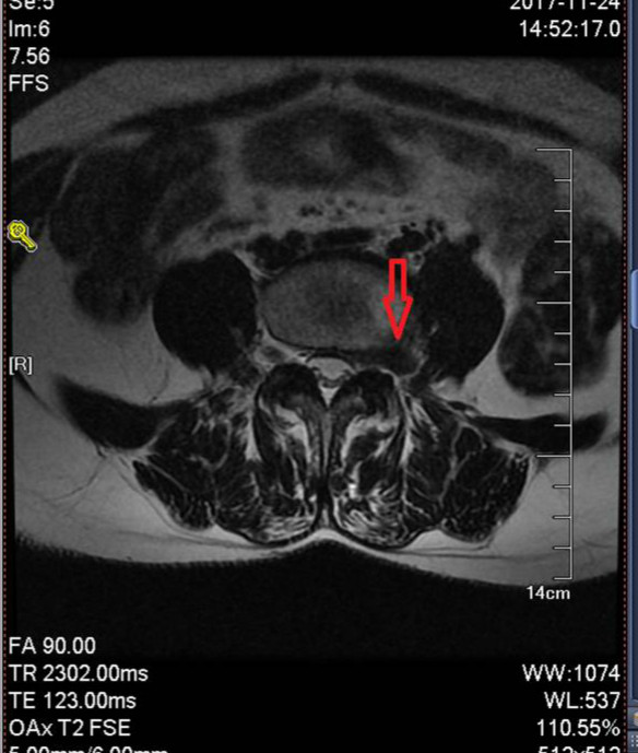 腰突和腰脱的磁共振片子,腰脱磁共振