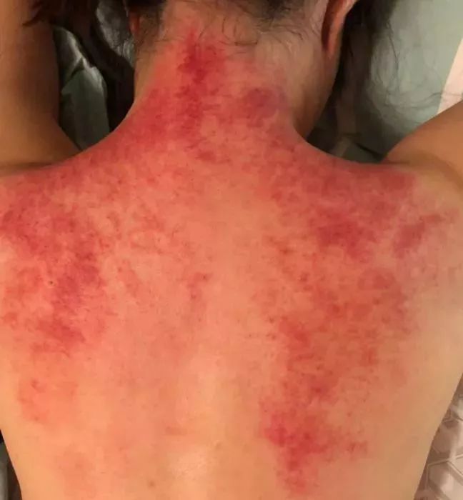 阿娇刮痧,阿娇刮痧养生视频