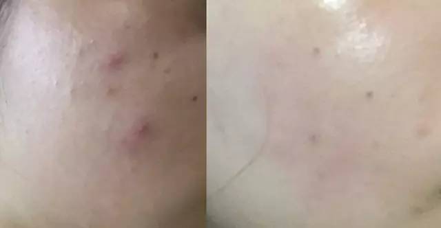 亲测｜烂脸才知道Albion健康水有多好